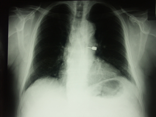 Torre_Chirurgia_Endoscopica_Corpi_Estranei