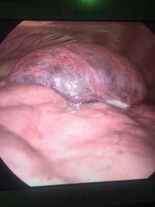 Torre_Pneumotorace_Endoscopica01